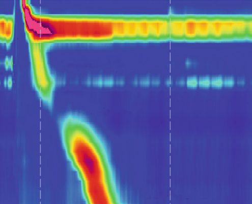 Oesophageal Manometry Albury Wodonga