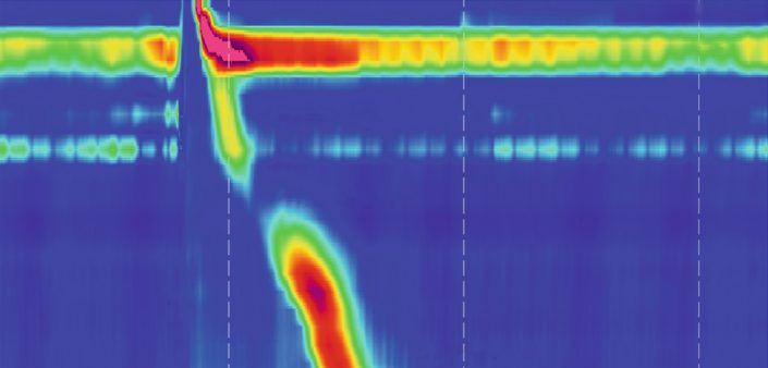 Oesophageal Manometry Albury Wodonga